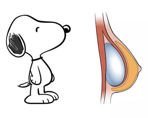 Snoopy Deformity Corrected Snoopy Deformity Corrected