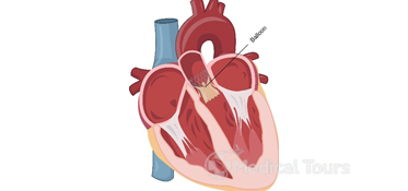 Balloon Valvuloplasty 
