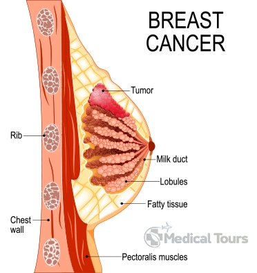 About Breast Cancer