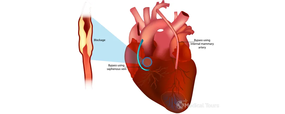 Coronary artery bypass surgery Coronary artery bypass surgery
