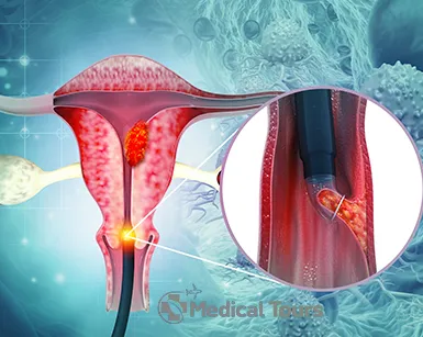 Cervical Cancer Treatment