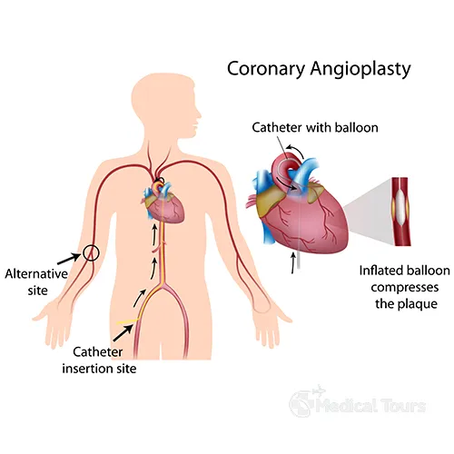 Coronary Angioplasty Coronary Angioplasty
