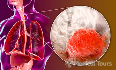 Esophageal /Oesophageal cancer Esophageal /Oesophageal cancer