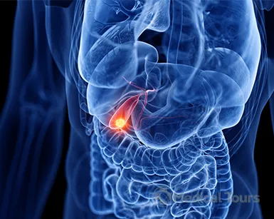 Gallbladder Cancer Gallbladder Cancer