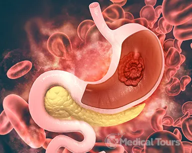 Stomach Cancer/Gastric Cancer