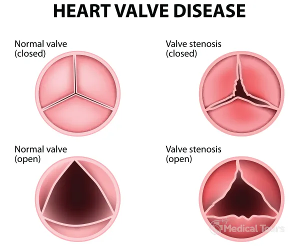Heart Valve Heart Valve