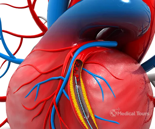 heart angioplasty heart angioplasty