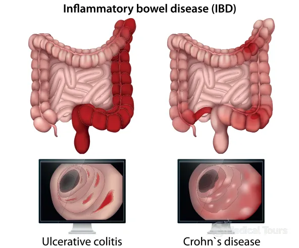 Inflammatory Bowel Disease