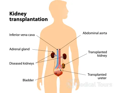 Kidney/Renal Transplant Kidney/Renal Transplant