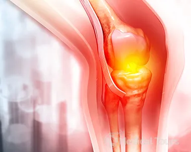 knee replacement surgery