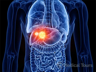 Liver Cancer