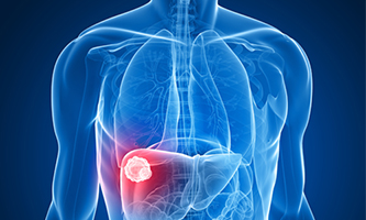 Liver Cancer