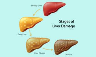 Liver Cirrhosis