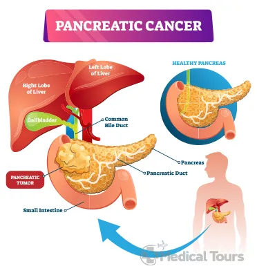 Pancreatic Cancer