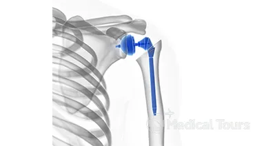 Partial Shoulder Replacement Surgery Partial Shoulder Replacement Surgery