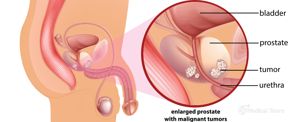Diagram of prostate cancer