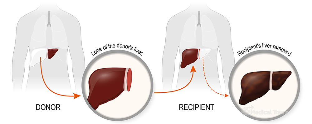 Liver Donor