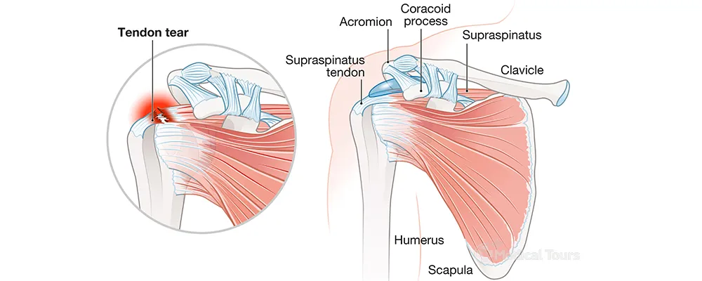 Rotator Cuff Rotator Cuff