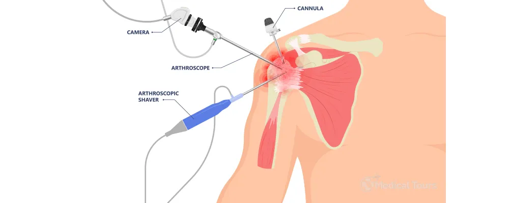 Shoulder Arthroscopy Shoulder Arthroscopy
