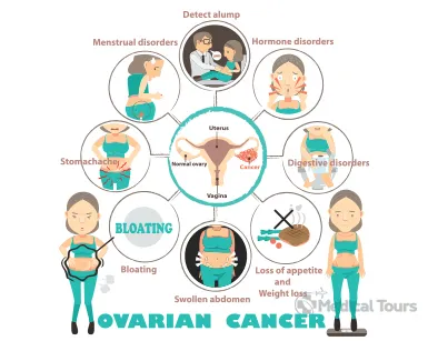 symptoms of ovarian cancer