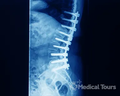 Spinal Fusion Surgery Spinal Fusion Surgery