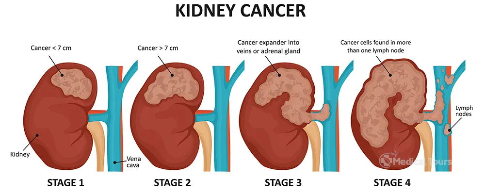 Stage of kidney cancer