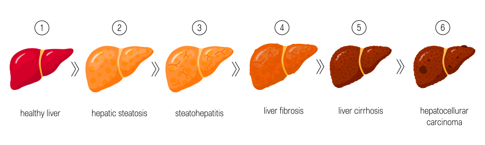 Treatment Options for Liver Cancer