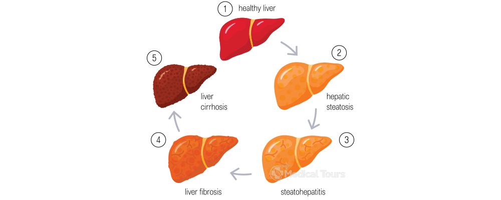 Stages of Liver Failure