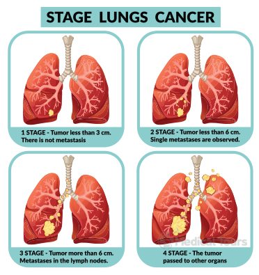 Lung Cancer Stage
