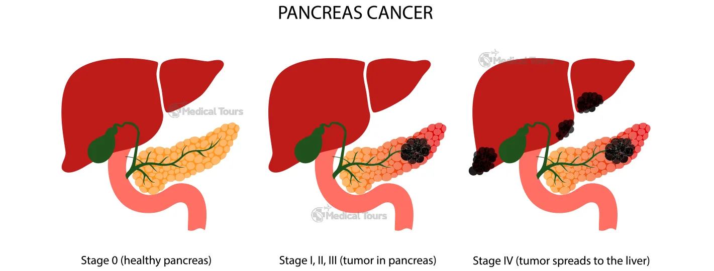 Stages of Pancreatic Cancer
