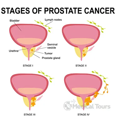 Stages of prostate cancer
