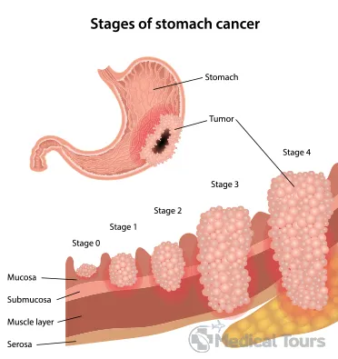 Stages of Stomach Cancer 