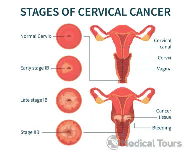 Stages of Cervical Cancer