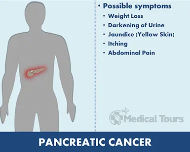 symptoms of pancreatic cancer