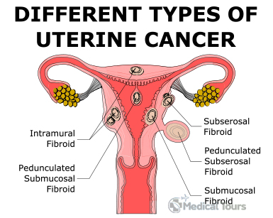 Symptoms of Uterine Cancer