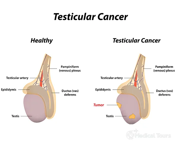 Testicular Cancer