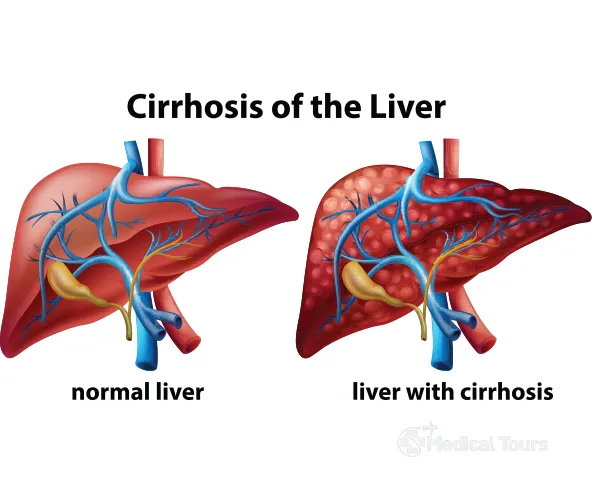 Liver Cirrhosis