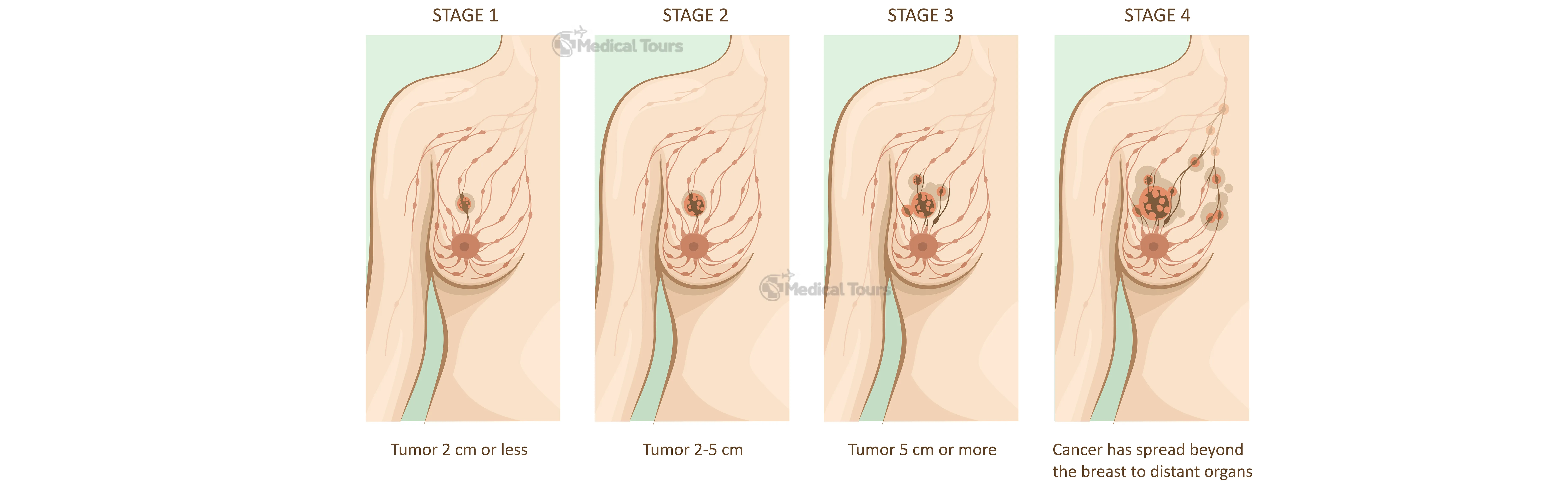 Stages of Breast Cancer