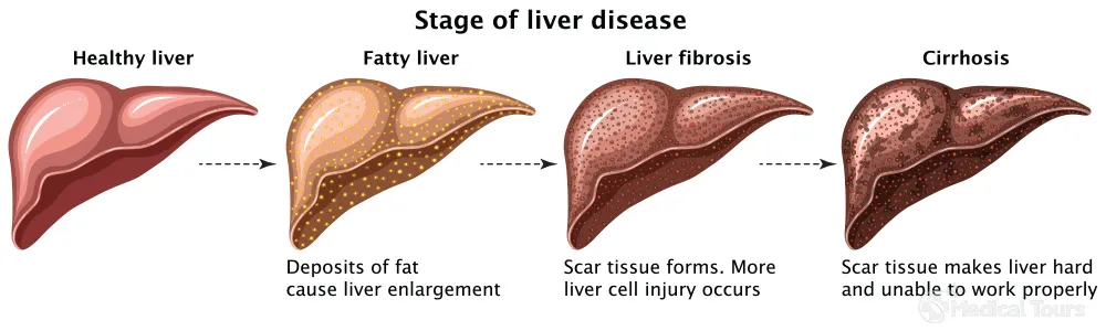 Stages of Liver Cirrhosis