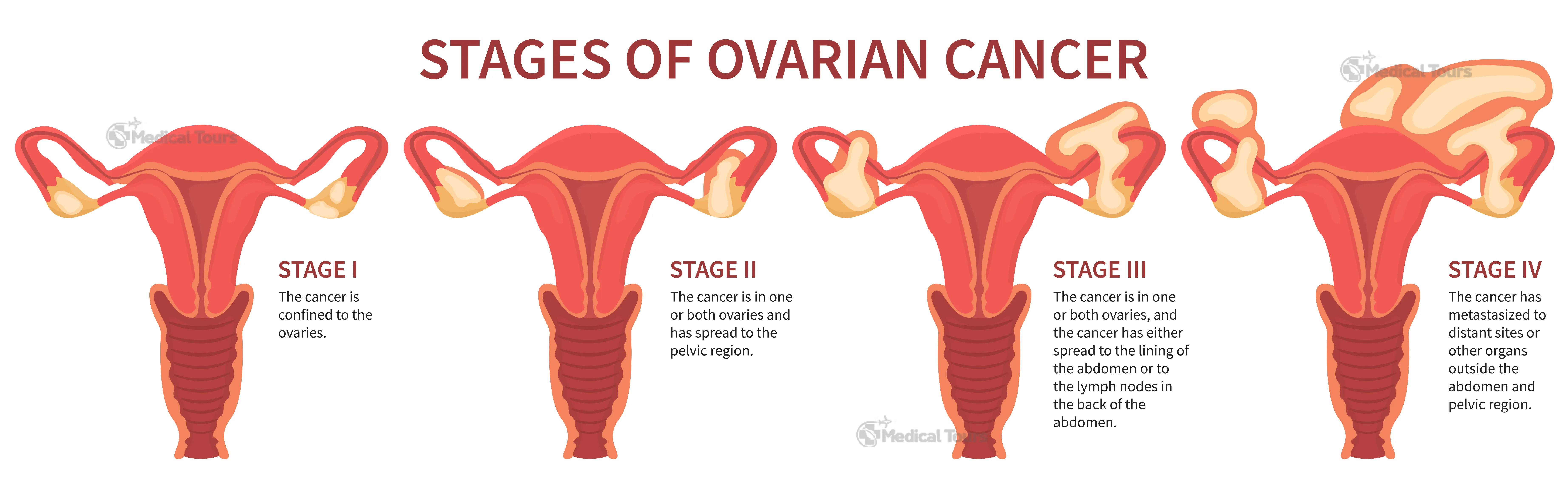 Stages of Ovarian Cancer