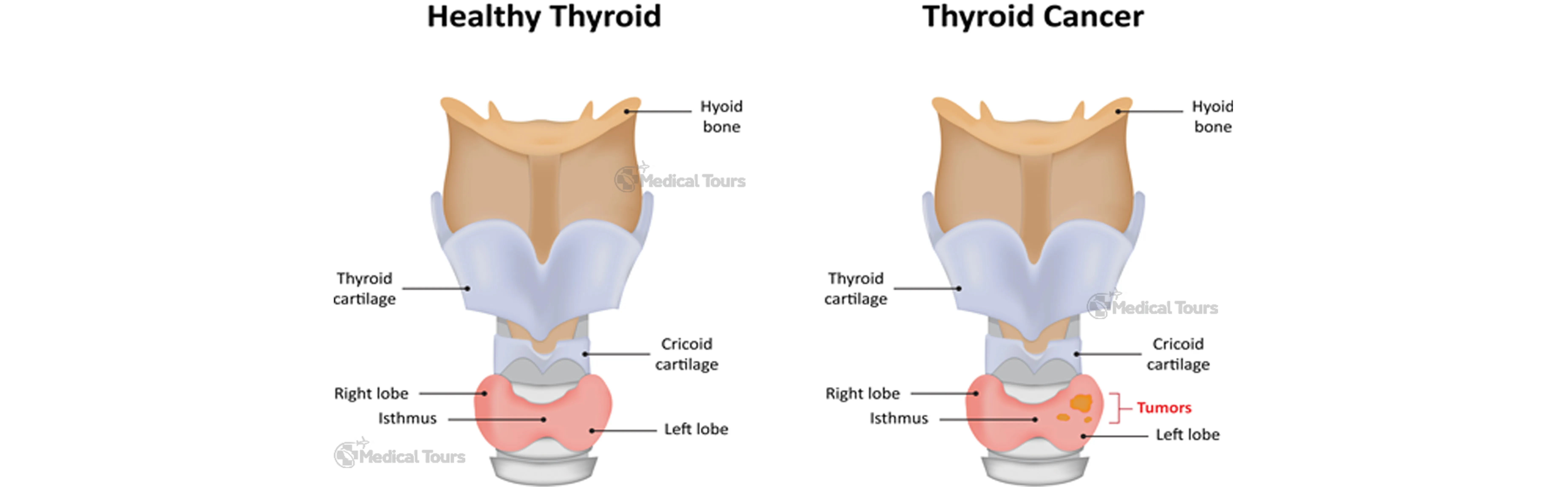 Thyroid Cancer