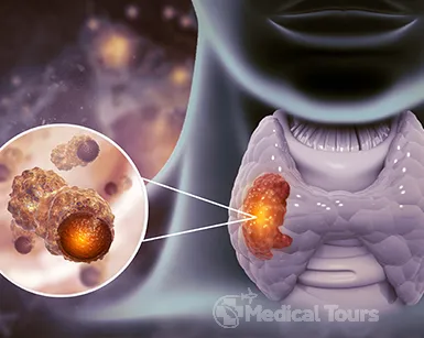 Thyroid Cancer