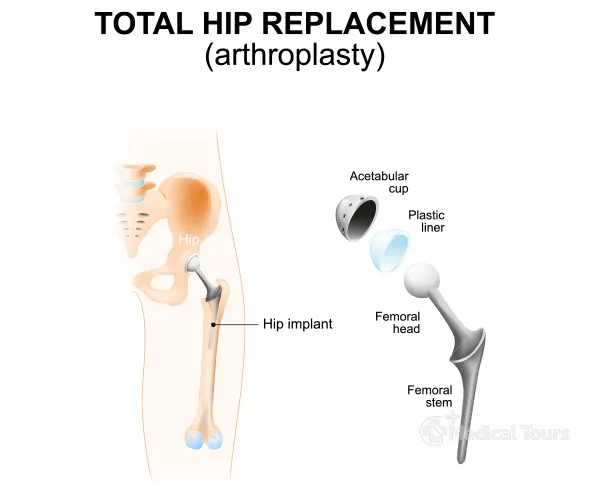 Total Hip Replacement Surgery