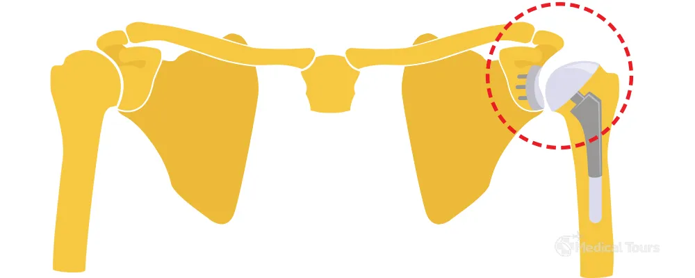 Total Shoulder Replacement Surgery Total Shoulder Replacement Surgery