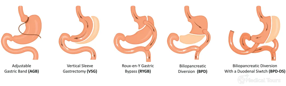 Types of Bariatric Surgery