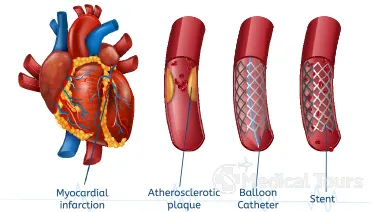 Types of Coronary Angioplasty Types of Coronary Angioplasty