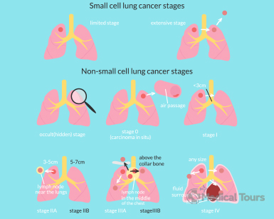 Types of Lungs Cancer