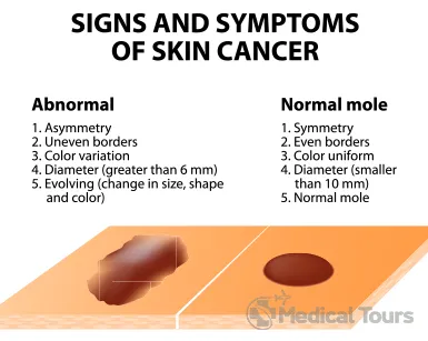 Types of Skin Cancer